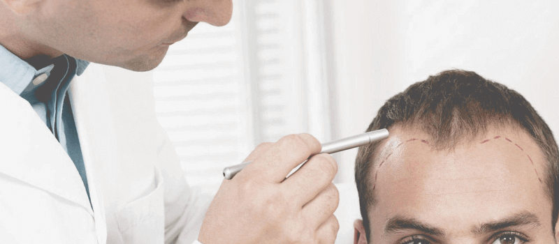 Hair Transplant Surgery Success Rate Igraft