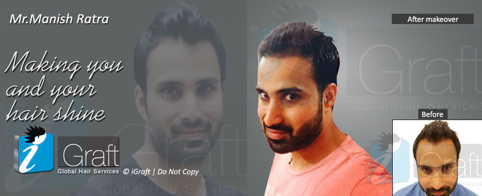 igraft hyderabad reviews by hair transplant clients igraft hyderabad igraft hyderabad reviews by hair