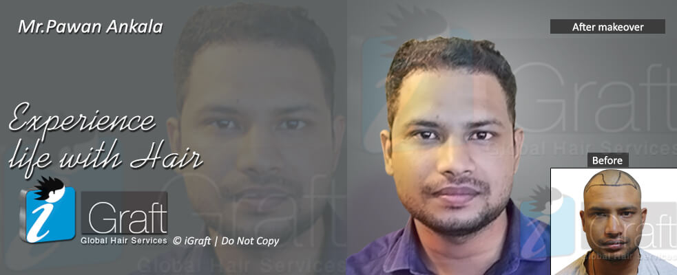 igraft hyderabad reviews by hair transplant clients igraft hyderabad igraft hyderabad reviews by hair