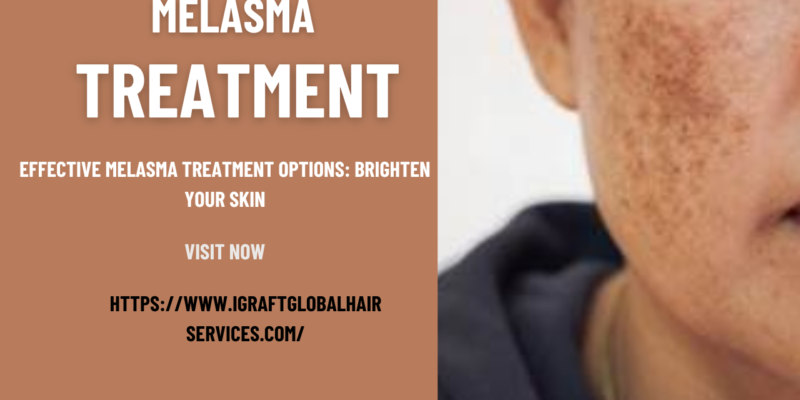 Melasma Treatment