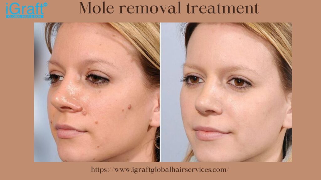 Mole removal treatment.