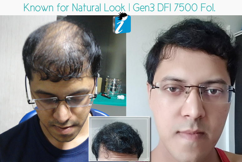Best hair transplant in Bangalore