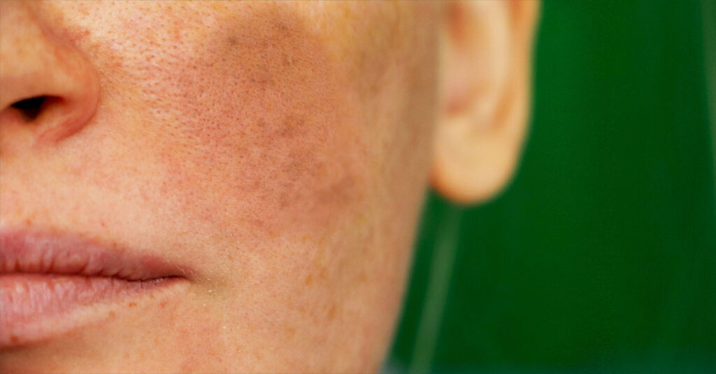 Melasma Treatment