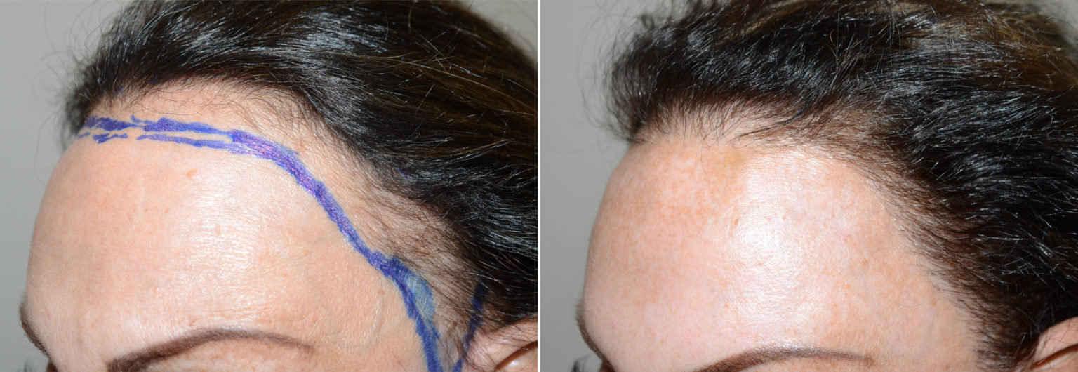 Unveiling iGraft Hair Transplant Costs