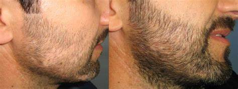 Beard and Eyebrow Hair Transplants at iGraft Pune