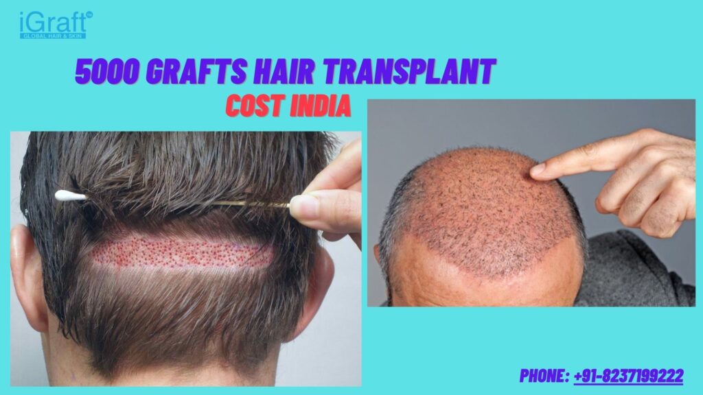 5000 grafts hair transplant cost india - iGraft Global