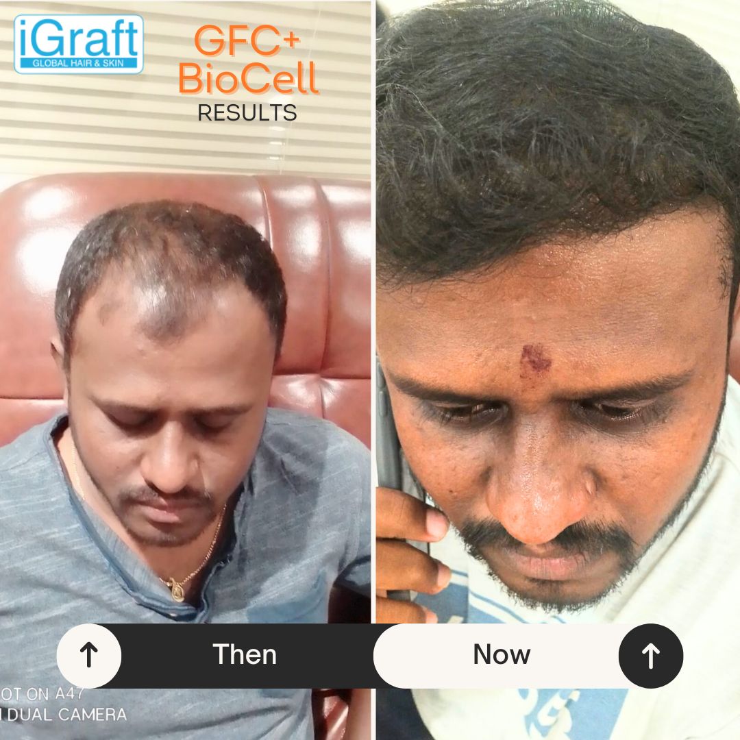 iGraft BioCell Hair Treatment post Hair Transplant Reviews Transformation Story, Better than GFC