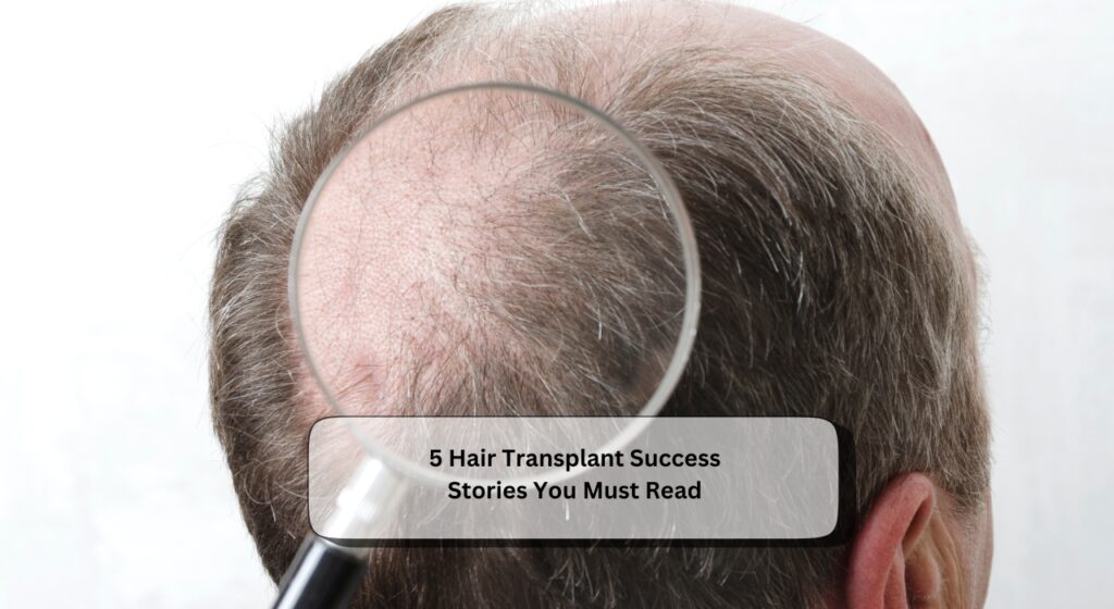 Hair Transplant Success Stories