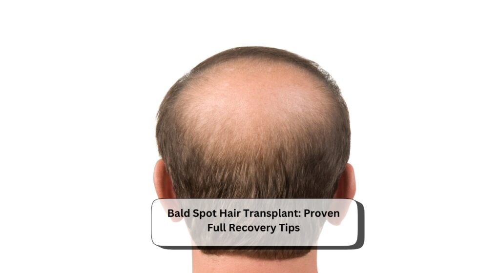 Bald Spot Hair Transplant
