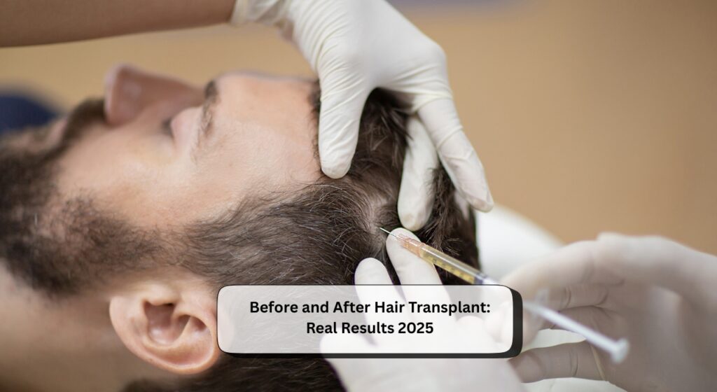 Before and After Hair Transplant