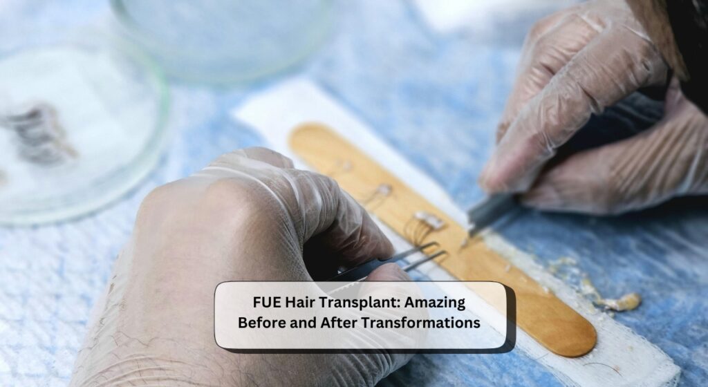 FUE Hair Transplant
