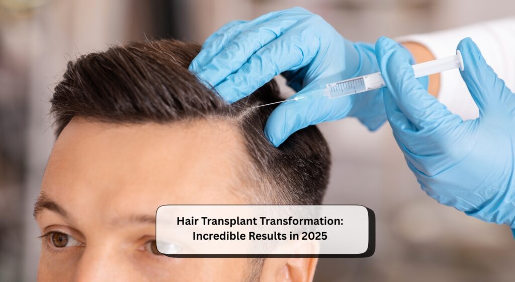 Hair Transplant Transformation