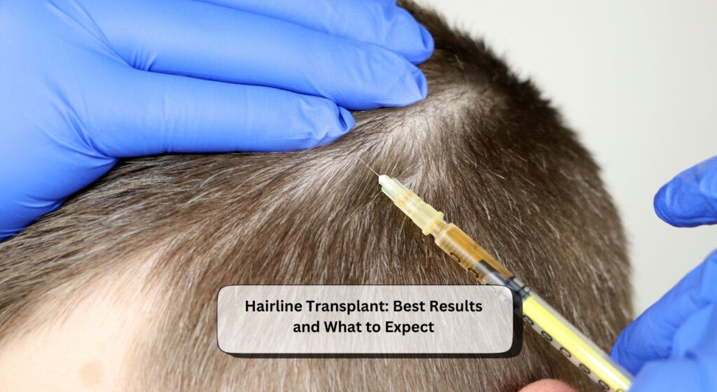 Hairline Transplant
