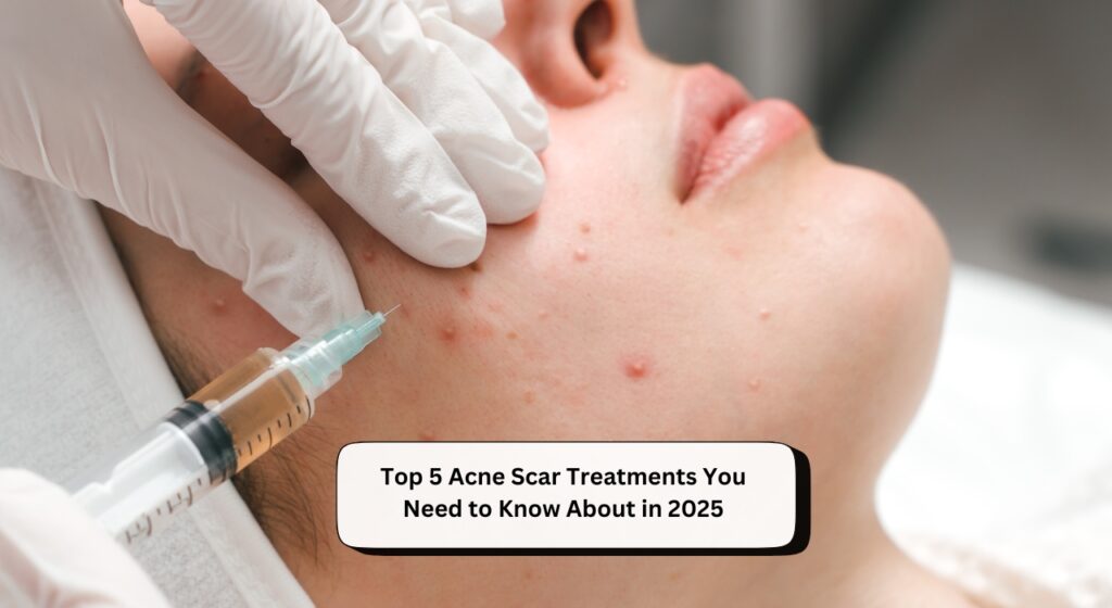 Acne Scar Treatments