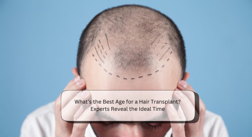 Best Age for Hair Transplant